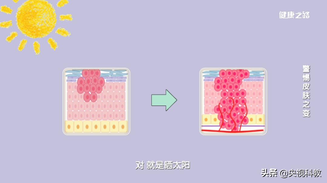 皮肤病毒疣的症状,皮肤疱疹病毒症状