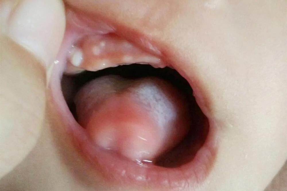 宝宝出牙症状顺序护理知识全攻略,长牙不按顺序出牙正常吗