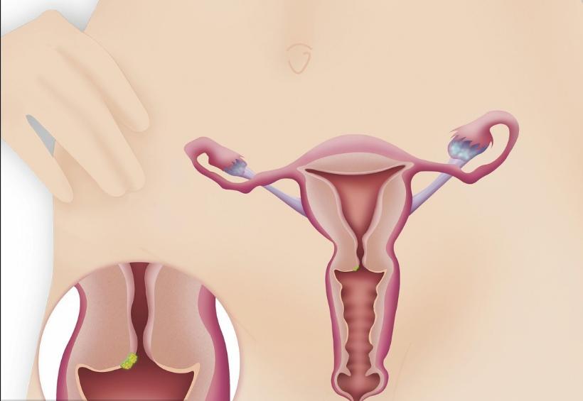 女人宫颈糜烂会影响月经量少吗,宫颈糜烂会对女性有哪些影响