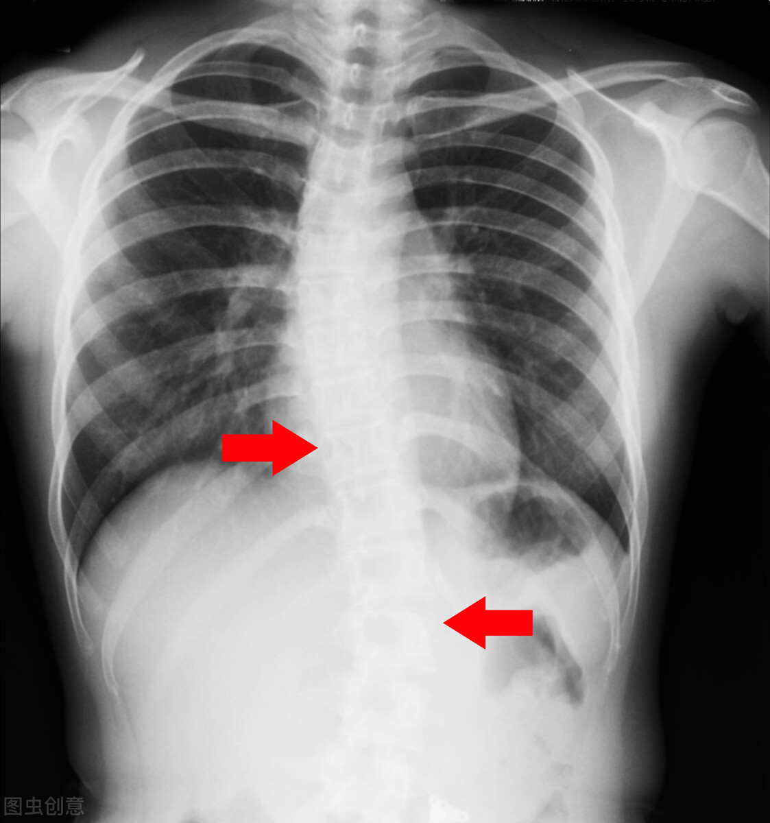成人s型脊柱侧弯40度怎么治疗,成人矫正脊柱侧弯的护具有效果么