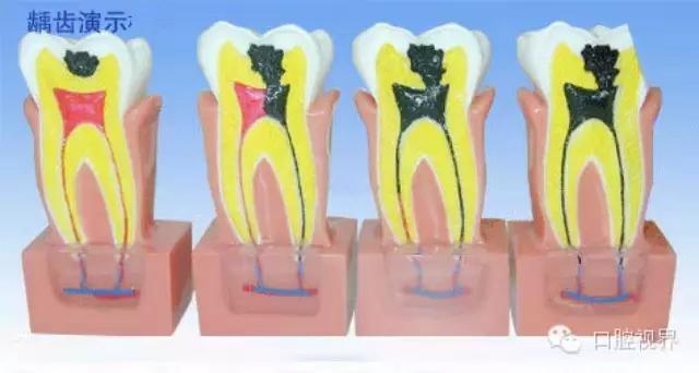 医生蛀牙没补干净怎么办,蛀牙小洞医生不建议补