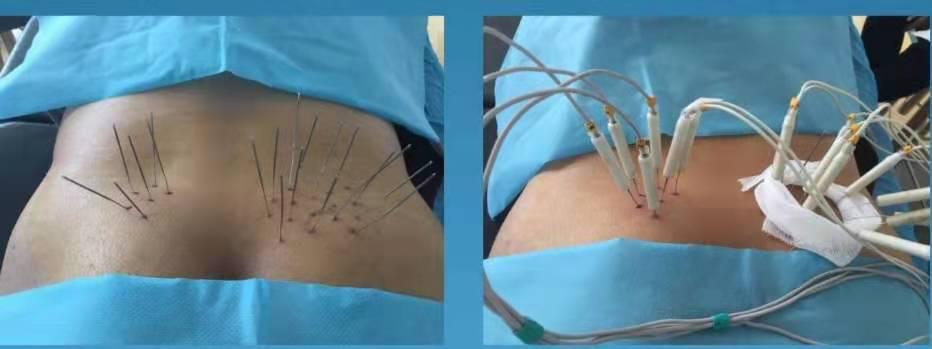 赶走疼痛，一身轻松！腰背痛，太原市中心医院疼痛科有妙招