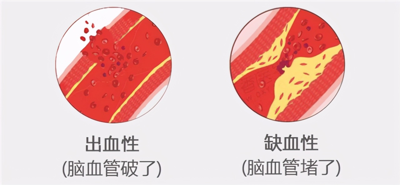 为防脑卒中能吃叶酸片吗,叶酸可预防脑卒中