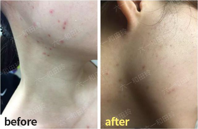 祛痘医美项目真实效果,祛痘印的医美项目对比