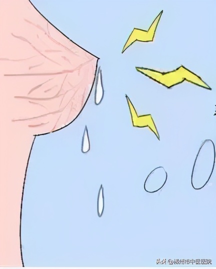 乳腺癌晚期乳头溢液,乳头清水溢液是癌吗