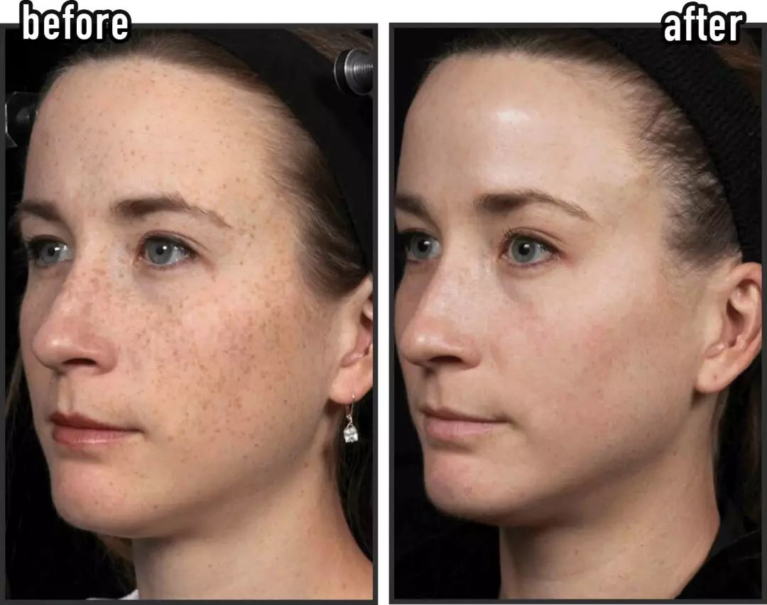 皮秒祛斑效果怎么样值得做吗,皮秒祛斑祛痣怎么样