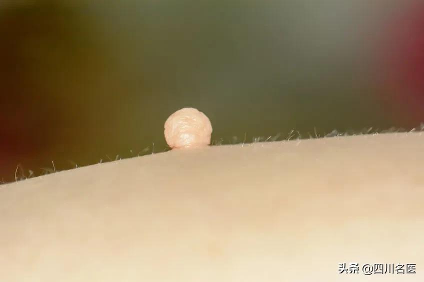 身上突然出现小肉揪,身上的小肉揪是什么