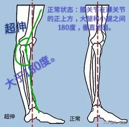 压腿很痛怎么办,为什么压腿时膝盖窝好痛