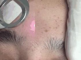 只需3步淡化斑点,简单4招快速淡化色斑