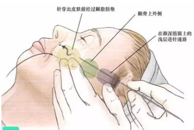 科普|光子嫩肤全攻略，做了光子后禁忌事项有哪些？