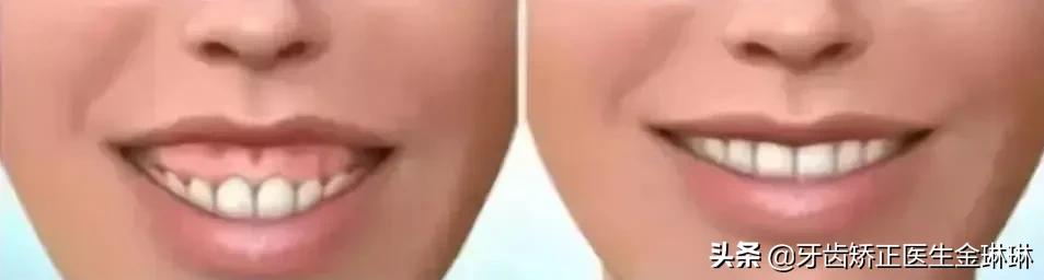露龈笑对颜值有多大影响,颜值杀露龈笑