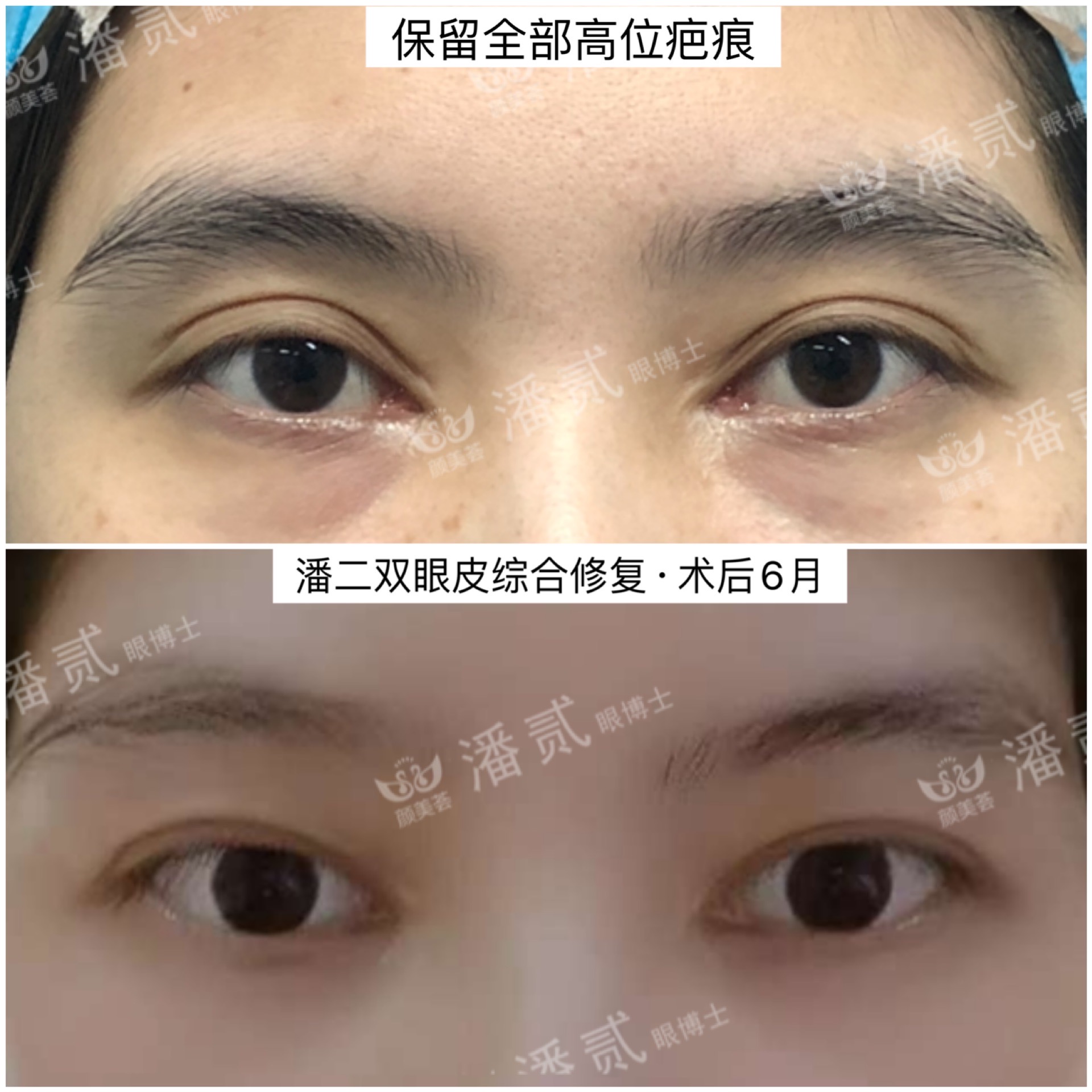 欧式大双眼皮和平行双眼皮,醒醒吧明智的放弃胜过盲目的执着