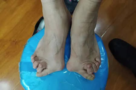 关节类风湿治疗原则,用中药哪种是治疗类风湿最佳方案