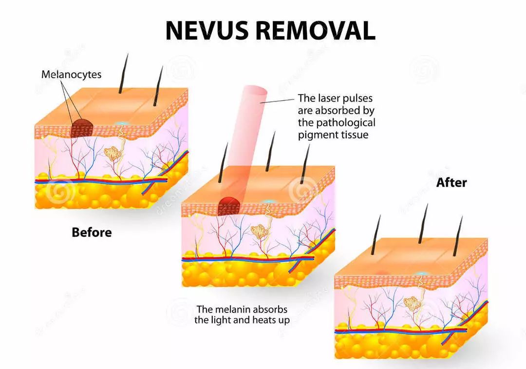 脸上有很多痣什么妙招可以祛痣,脸上长痣怎么祛痣最有效