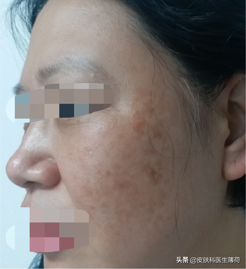 黄脸婆吃什么祛斑,告别黄脸婆自制纯中药祛斑面膜