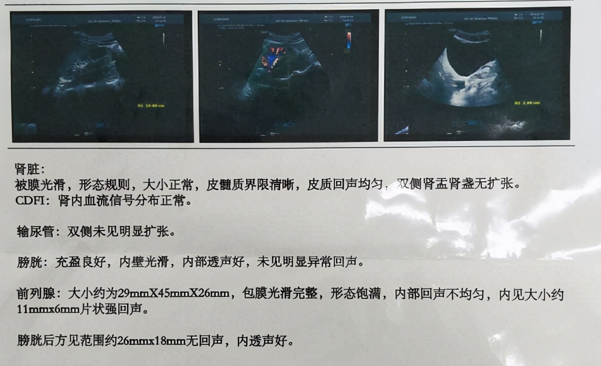 3个方法轻松解决前列腺疾病,如何快速有效的治疗前列腺疾病