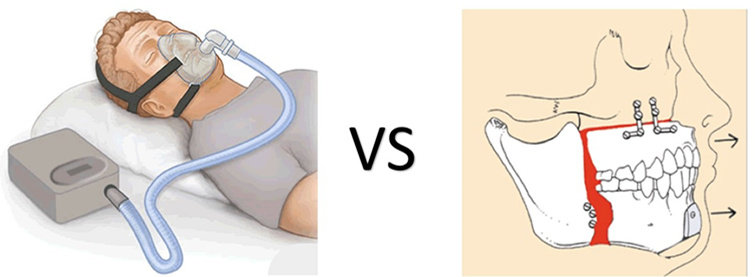 下巴短小怎么办不整容可以改变吗,下巴短后缩下颌线不明显怎么改善