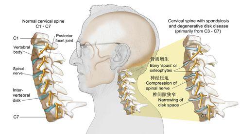 颈椎曲度康复案例,颈椎病康复科普文章图片