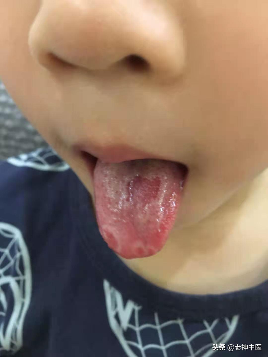 小孩子脾胃虚弱舌苔脱落怎么调理,儿童舌苔脱落如何食疗