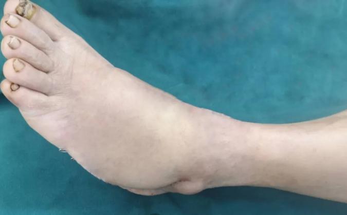 中年男子不慎撞伤左脚，手外科移花接木完美修复！