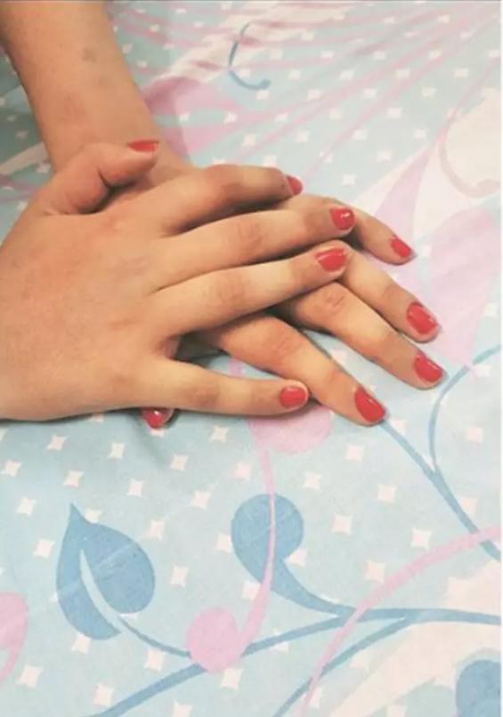 印度少女移植男性黝黑双手,肤色神奇变白,嫩滑无毛如纤纤玉手