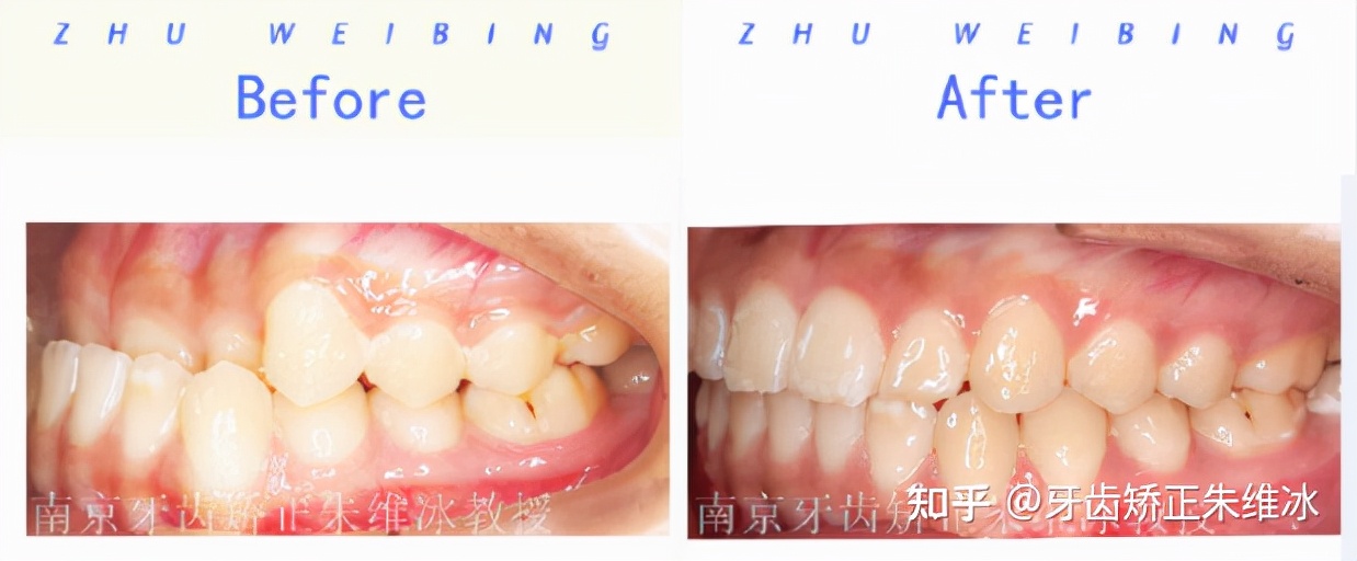 南京透明式牙齿矫正器地包天,18岁功能性地包天能改善面型吗