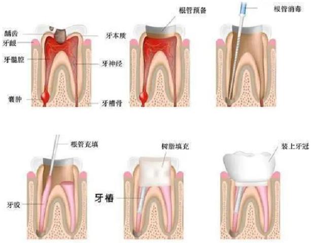 治疗虫牙和补牙要多少钱,治疗虫牙里面放的是什么药