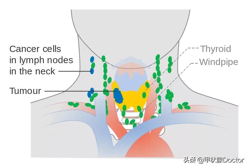 甲癌淋巴结转移颈部全切脸会肿,甲癌淋巴转移多少要做碘131