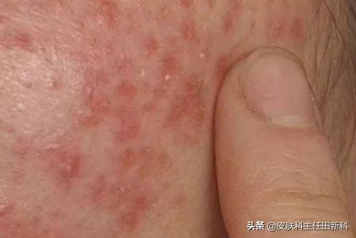 脸上成片斑是哪里出了问题,脸上痘印变成癣了怎么回事