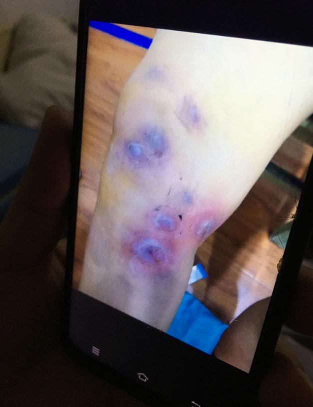 针灸感染,河南诊所针灸感染