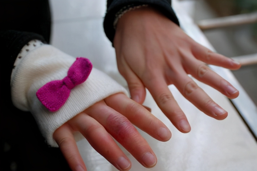 冻疮引起的白癜风会扩散吗,白癜风导致冻疮怎么治