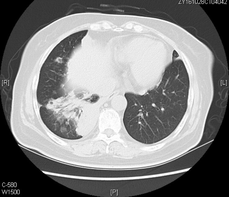 黏液腺癌基本不转移不复发,肺粘液腺癌转移了还能治好吗