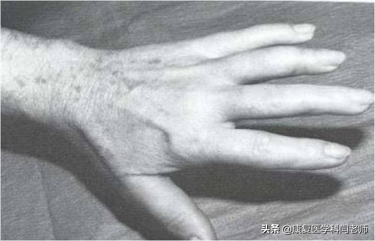 脑卒中后偏瘫患者常见并发症:肩手综合征的康复治疗
