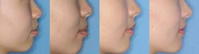 为什么有那么多人矫正牙齿,成年人千万不要做牙齿矫正