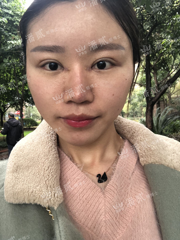 开眼角过大图片,开眼角过大修复效果图