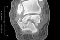 摔跤后骨折保守治疗,摔跤后脚跟痛怎么解决