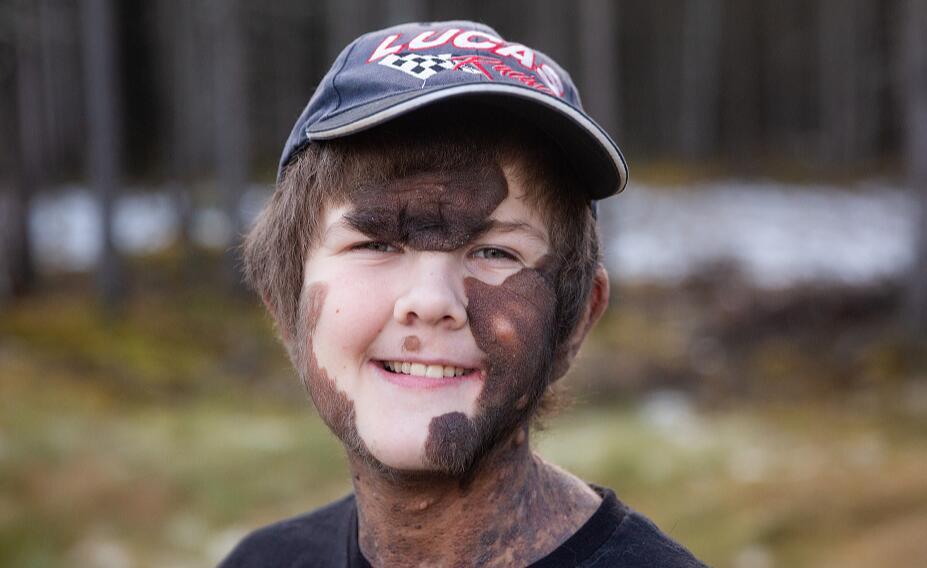 美国男孩患罕见疾病,美国男孩患绝症