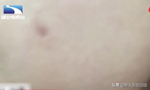 19岁女子打钢钉“种”酒窝，不料遇上庸医，感染发炎差点毁容