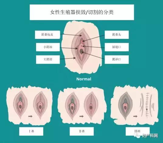 昆士兰指南,会阴护理最新指南