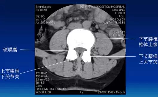 腰椎退行性变腰椎间盘轻度突出,椎间盘突出并膨出继发椎管狭窄