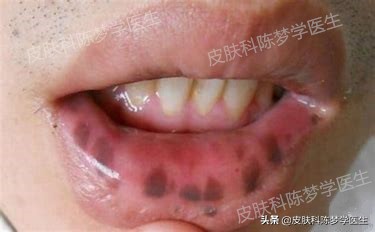 褐青斑是雀斑样痣吗,脸上太田痣怎么祛斑