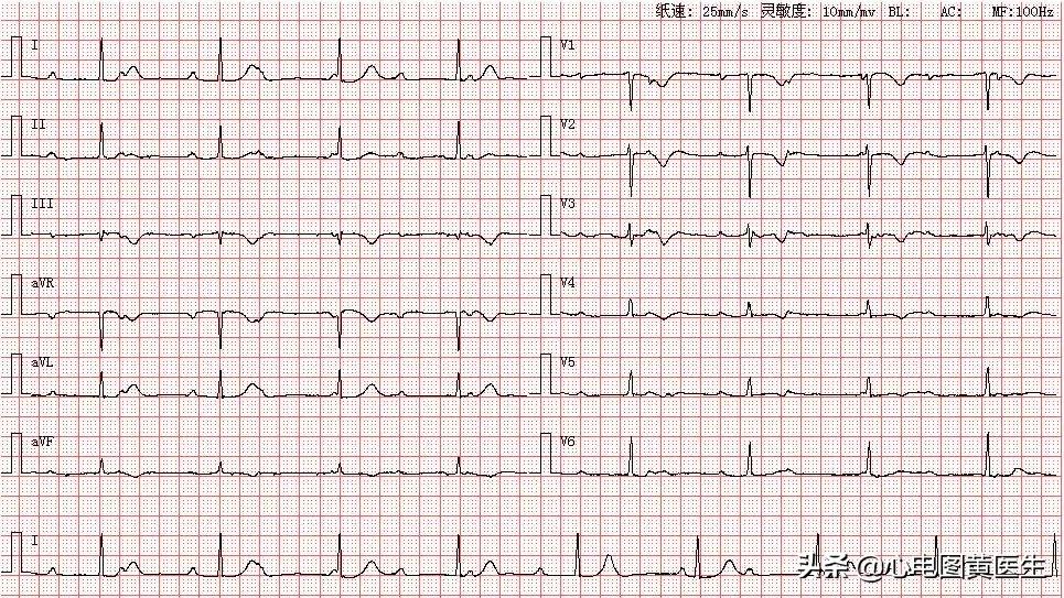 心电图出现qrs电压交替现象,心电图出现u和t波倒置