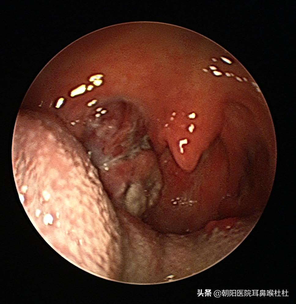别拿扁桃体发炎不当回事