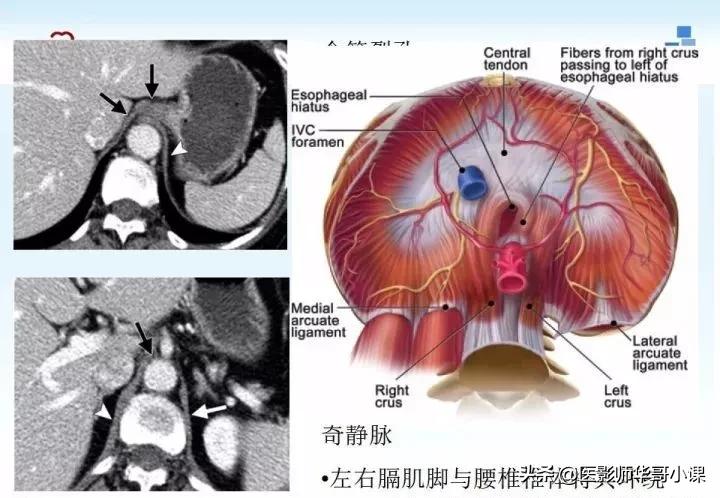 「精品课件」胸部膈肌的解剖及常见病变影像的表现