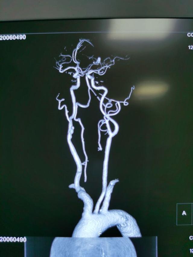 急性脑梗死支架取栓用开颅吗,急性脑梗死支架取栓视频