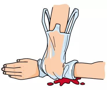 临床中各种出血的急救方法全套攻略