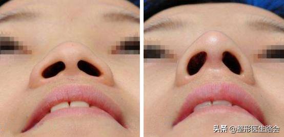 鼻头变大如何修复,鼻修复半年了鼻头变大怎么办