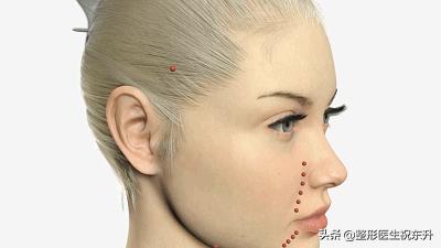 面部线雕一般能保持多久,医生不建议做线雕的原因