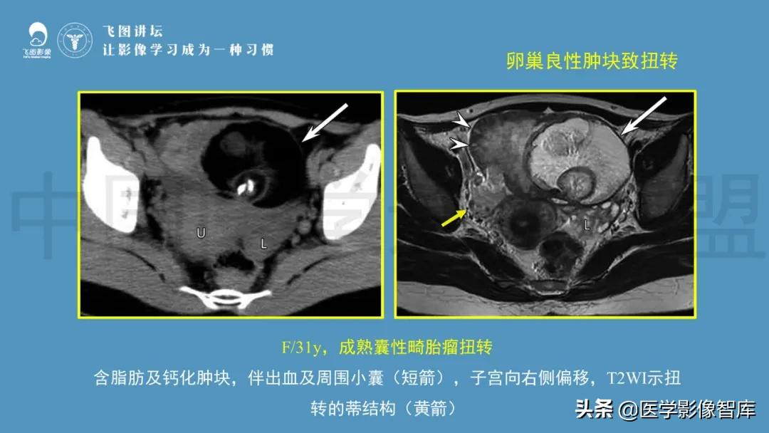 子宫解剖结构输卵管和卵巢位置,子宫附件ct影像学正常解剖表现