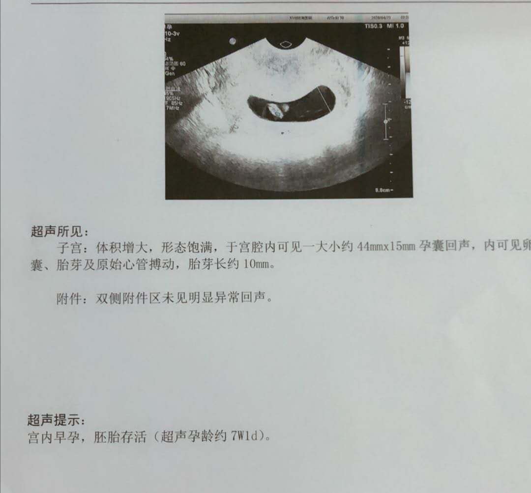 四维超声和二维b超的区别,产检b超比前两次小